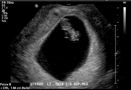 Monochorionic Diamniotic Twin Pregnancy In A Didelphys Uterus | Image ...