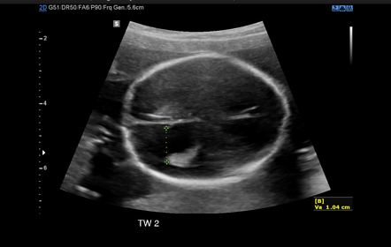 Neural Tube Defect In Monochorionic Diamniotic Twin Pregnancy | Image ...