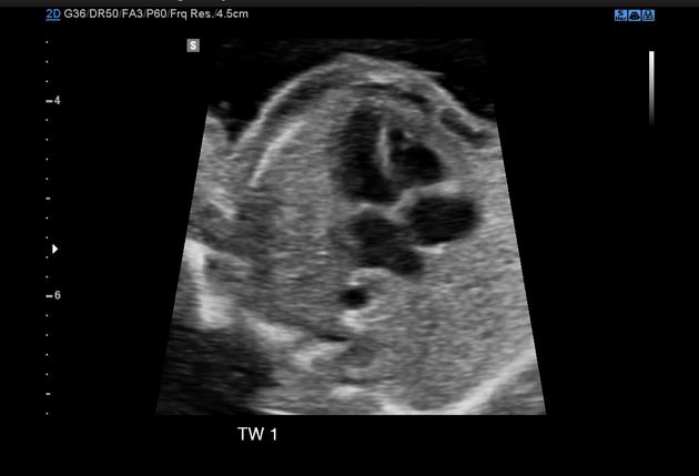 Normal vs. Abnormal Fetal Heart Rate