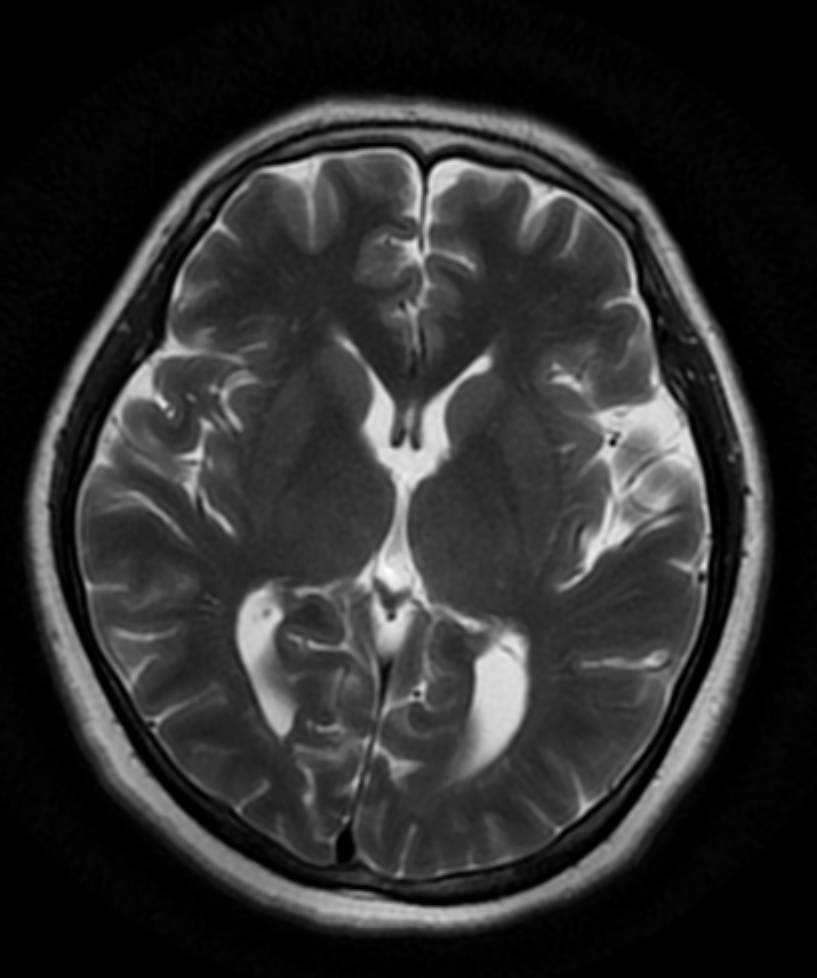 Pericallosal Lipoma 