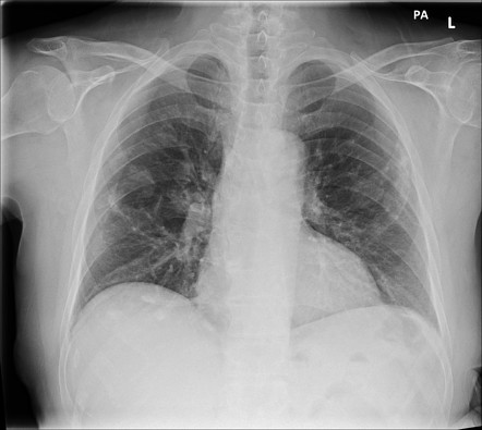 Calcified pleural plaques | Radiology Case | Radiopaedia.org