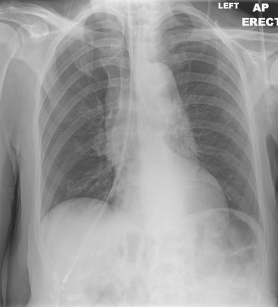 Endobronchial nasogastric tube | Radiology Case | Radiopaedia.org