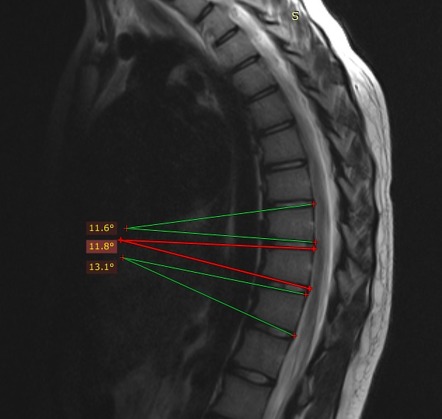 Scheuermann disease | Image | Radiopaedia.org