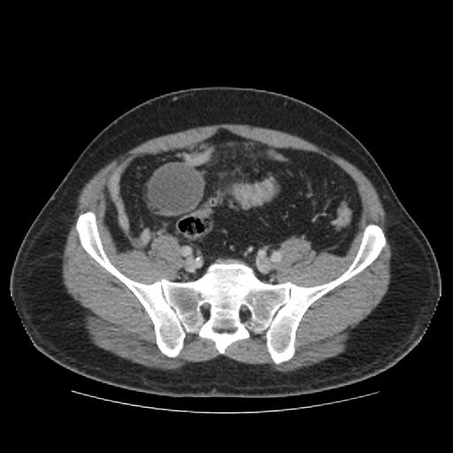 Mucocele Of The Appendix Image