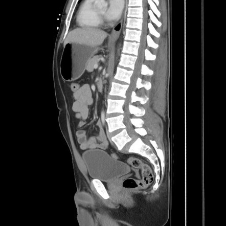 Blunt abdominal trauma with solid organ and musculoskelatal injury with ...