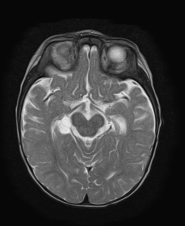 Choroidal fissure cyst | Image | Radiopaedia.org