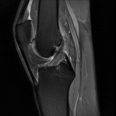 Osteochondritis dissecans - knee | Image | Radiopaedia.org