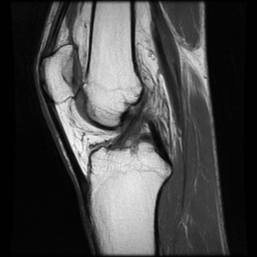 Osteochondritis dissecans - knee | Image | Radiopaedia.org