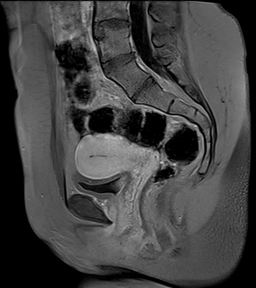 Ovarian endometrioma | Image | Radiopaedia.org