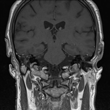 Cholesteatoma | Image | Radiopaedia.org