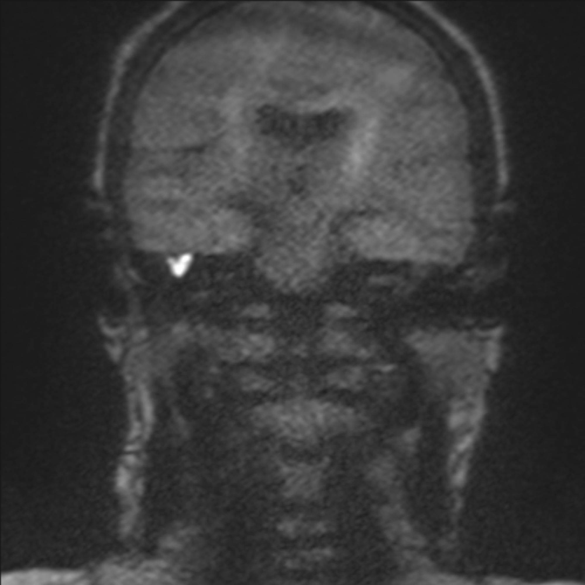 Cholesteatoma | Image | Radiopaedia.org