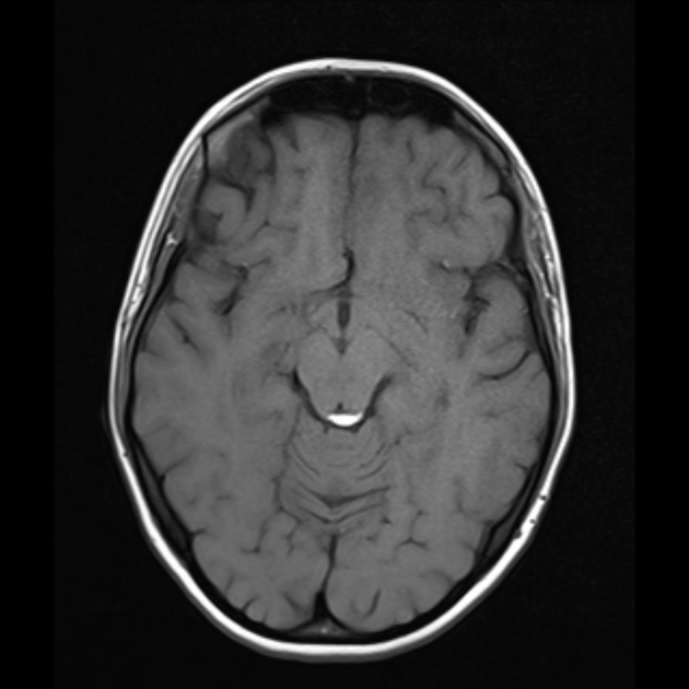 quadrigeminal cistern lipoma