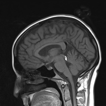 Quadrigeminal cistern lipoma | Image | Radiopaedia.org