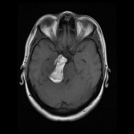 Ruptured intracranial dermoid cyst | Radiology Case | Radiopaedia.org