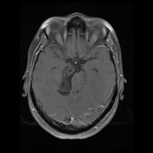 Ruptured Intracranial Dermoid Cyst Image