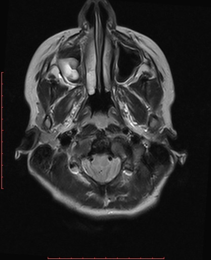 Chiari 1.5 malformation | Image | Radiopaedia.org