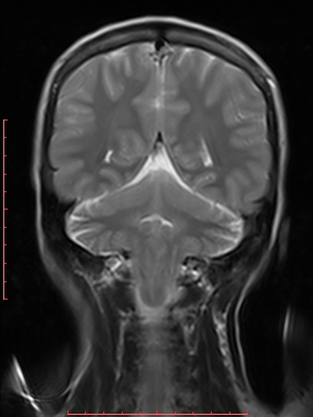 Chiari 1.5 malformation | Image | Radiopaedia.org