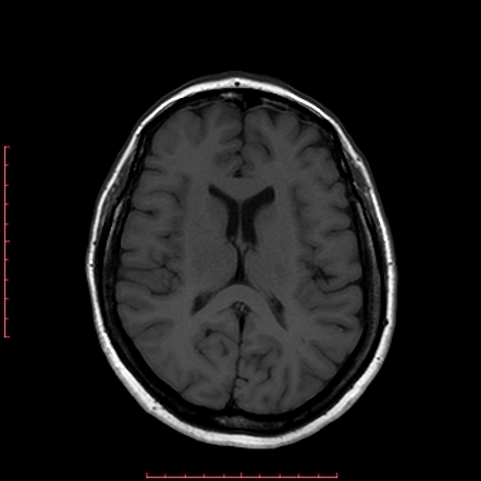 Pseudotumor Cerebri (idiopathic Intracranial Hypertension) | Radiology ...