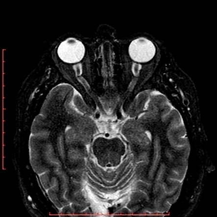 Pseudotumor cerebri (idiopathic intracranial hypertension) | Radiology ...