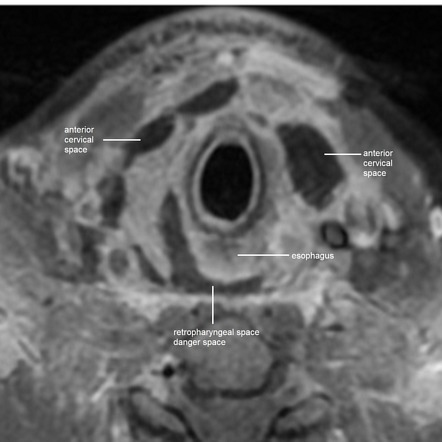 Retropharyngeal abscess and necrotizing fasciitis in neck complicated ...