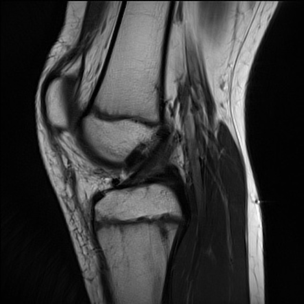 Osgood-schlatter Disease 