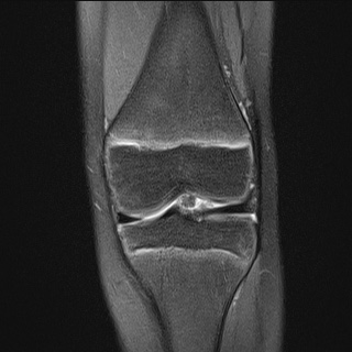 Osgood-Schlatter disease | Image | Radiopaedia.org