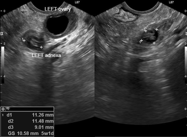 Ectopic Pregnancy Ultrasound 