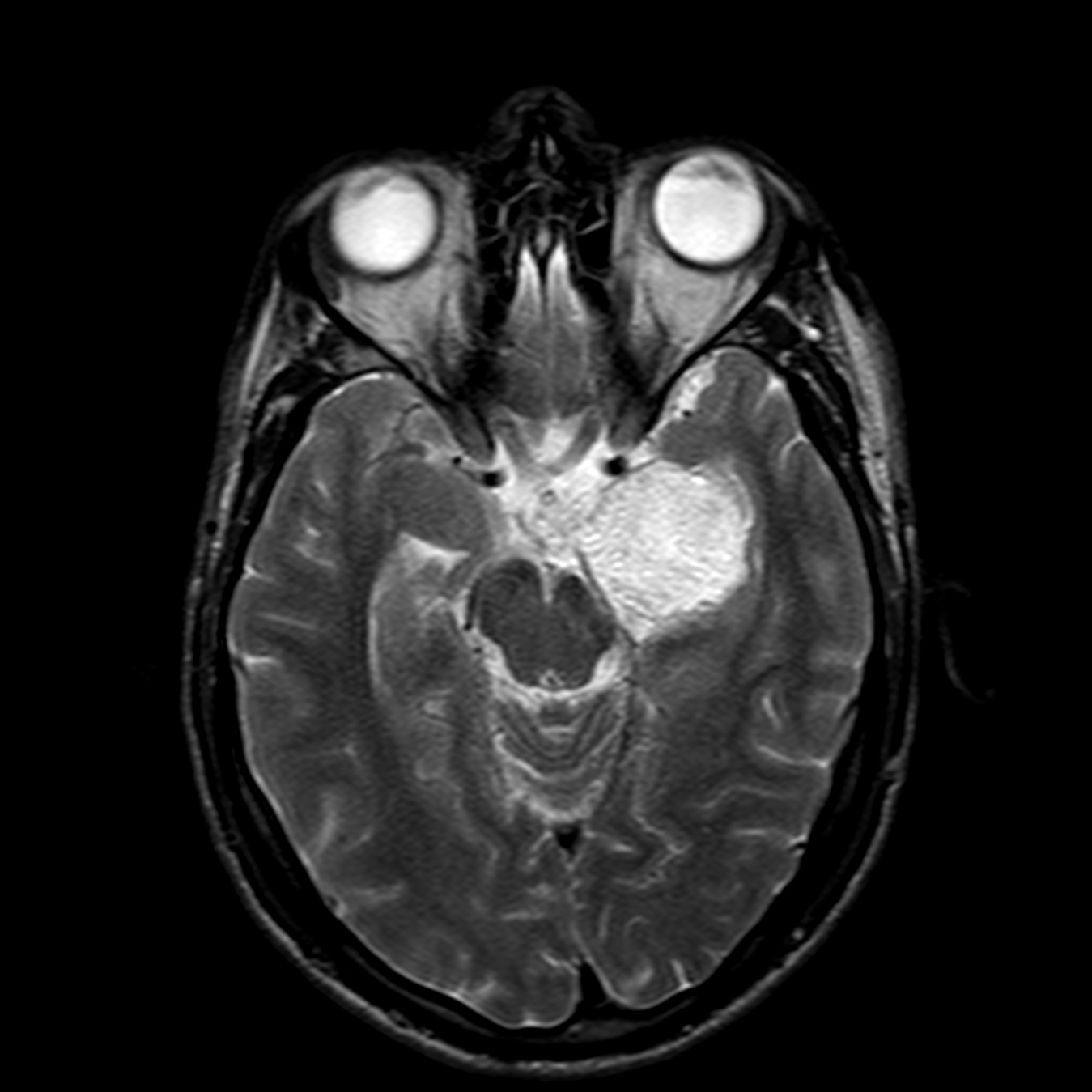 Intracranial Dermoid Cyst Ruptured Image 3260