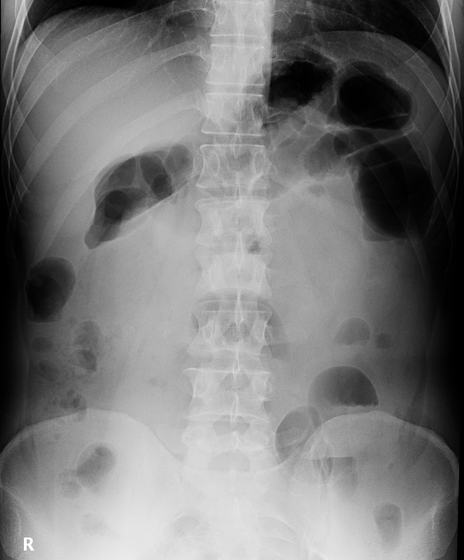 Normal Abdominal X Ray