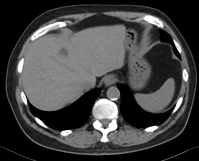 Steatohepatitic hepatocellular carcinoma (SH-HCC) | Image | Radiopaedia.org