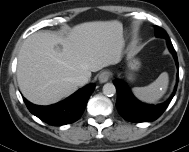 Steatohepatitic hepatocellular carcinoma (SH-HCC) | Image | Radiopaedia.org