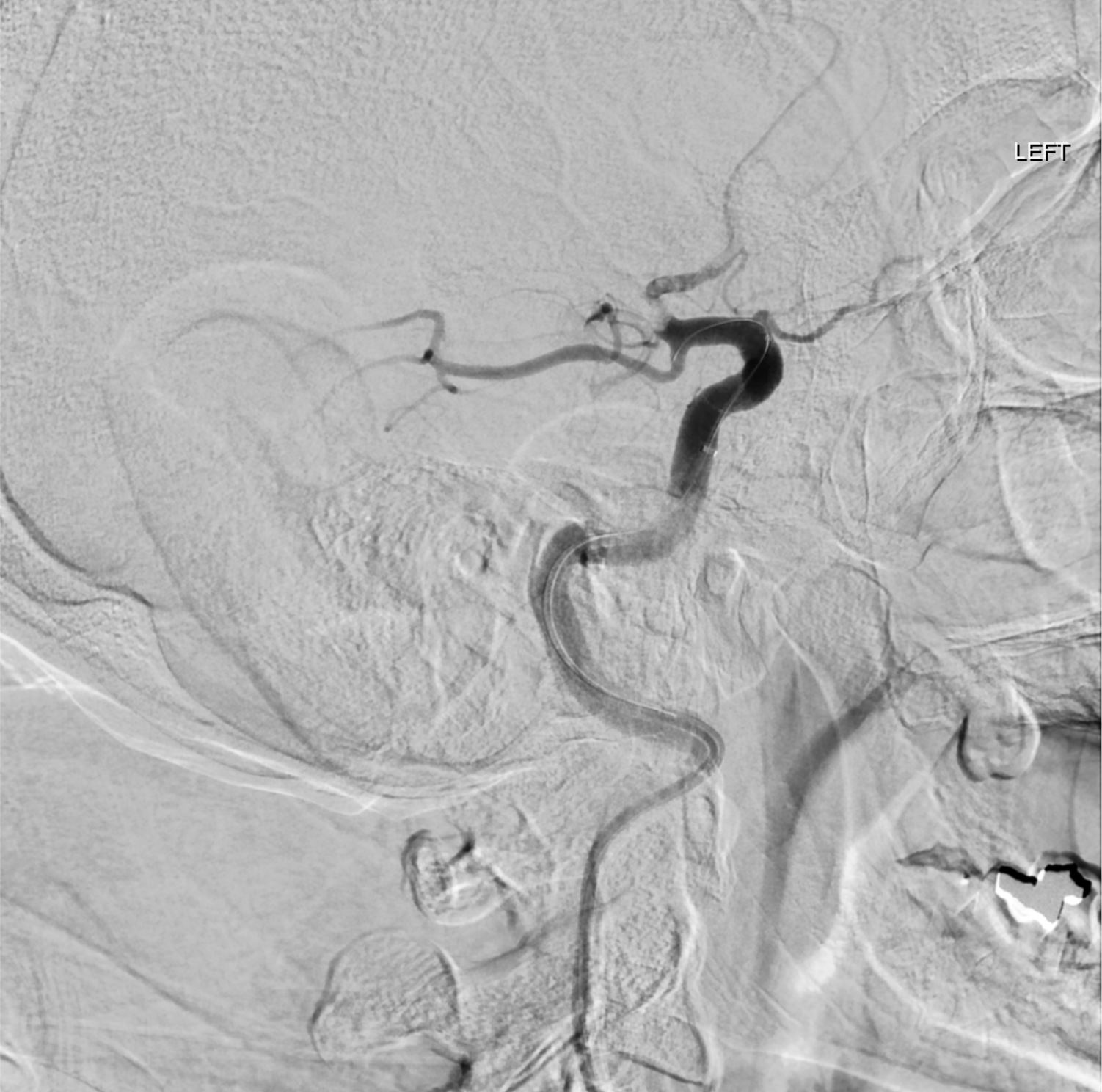 middle-cerebral-artery-neuroangio