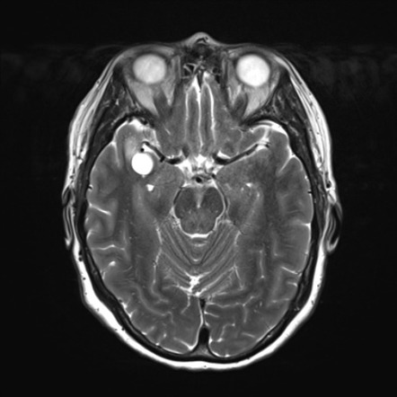 Anterior temporal pole perivascular space | Radiology Case ...