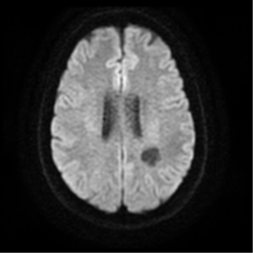 Perivascular space - tumefactive | Image | Radiopaedia.org