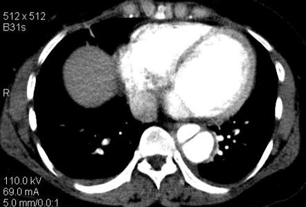 Stanford Type B Aortic Dissection | Radiology Case | Radiopaedia.org