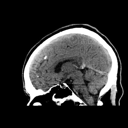 Deep cerebral veins thrombosis and thalamic venous infarction | Image ...