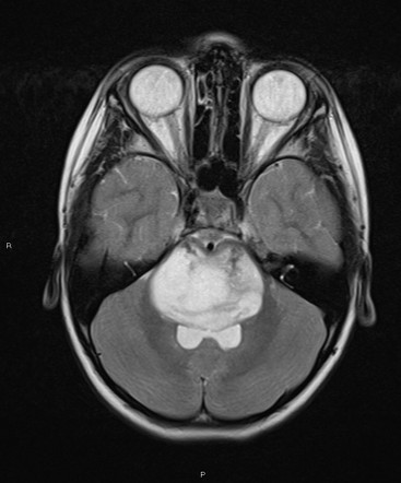 Diffuse midline glioma H3-K27M-mutant | Radiology Case | Radiopaedia.org