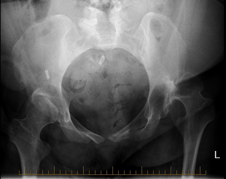 Girdlestone procedure | Image | Radiopaedia.org