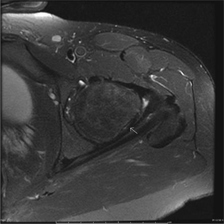 Acetabular Labral Tears | Radiology Reference Article | Radiopaedia.org