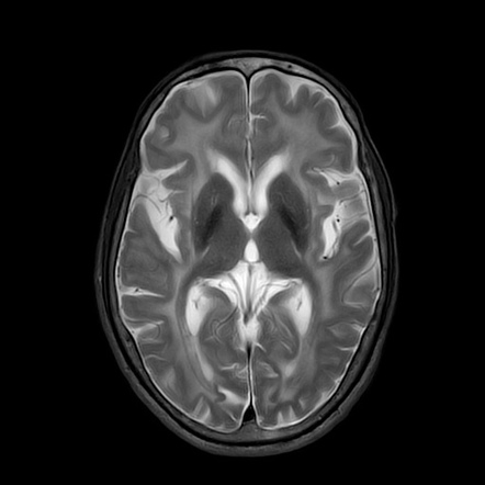 HIV encephalopathy | Image | Radiopaedia.org