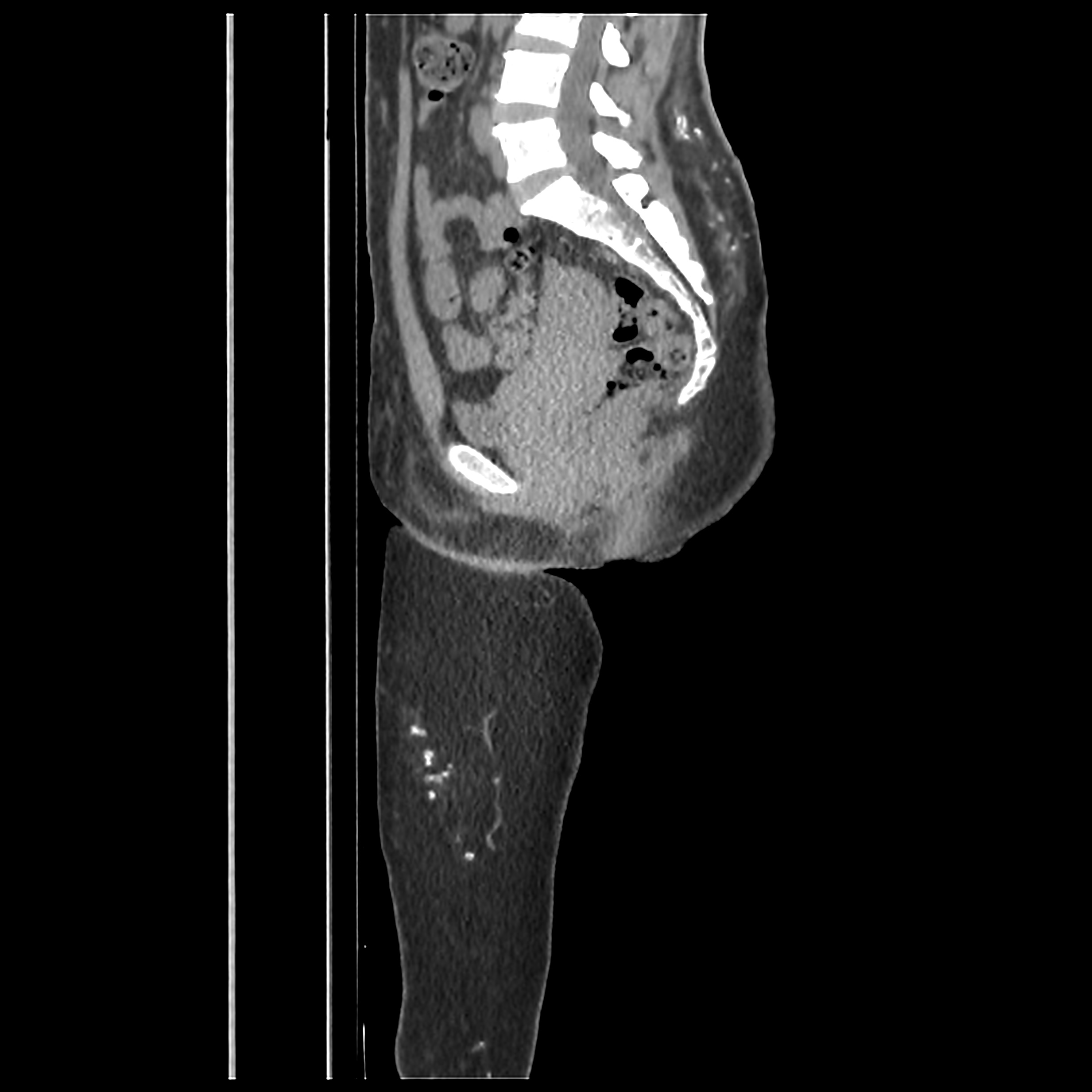 iatrogenic-allogenosis-image-radiopaedia