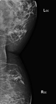 Cleavage View Radiology Reference Article Radiopaedia Org