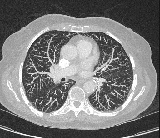 Pseudomyxoma Peritonei Image Radiopaedia Org