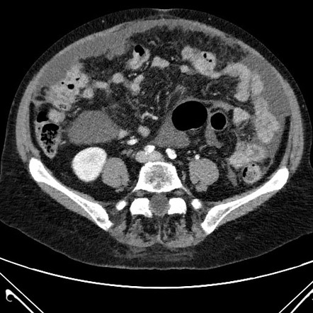 Pseudomyxoma Peritonei | Image | Radiopaedia.org