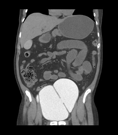 Urinary bladder diverticulum | Radiology Case | Radiopaedia.org