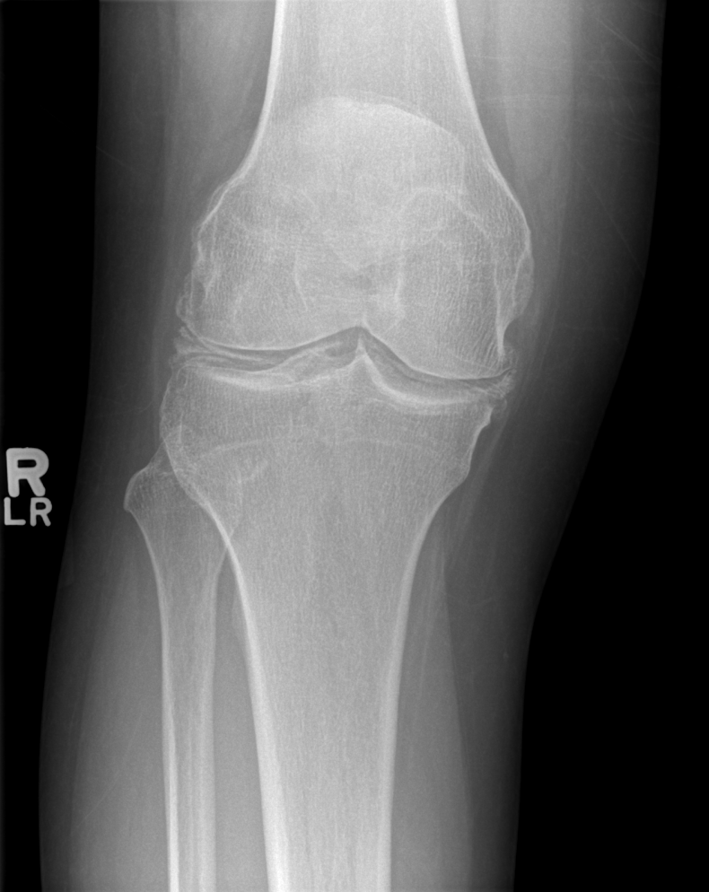 Calcium pyrophosphate dihydrate deposition disease | Image ...