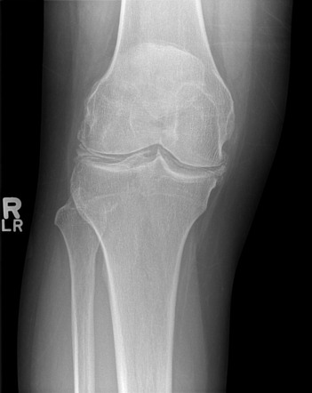 Calcium pyrophosphate dihydrate deposition disease | Image ...