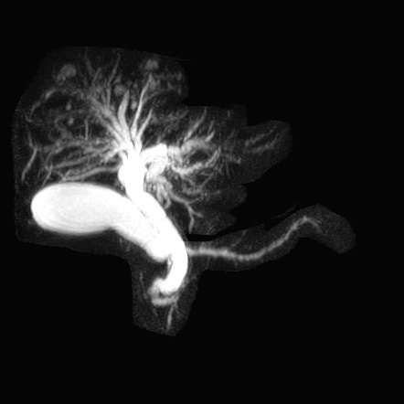 AIDS cholangiopathy | Radiology Reference Article | Radiopaedia.org