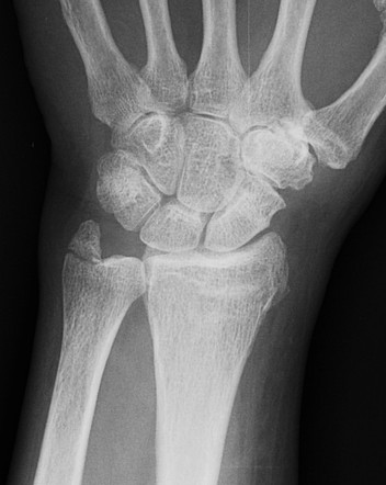 Distal radius fracture - Frykman type VIII | Radiology Case ...