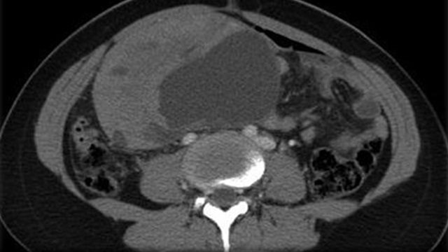 Ovarian Mucinous Cystadenoma Image